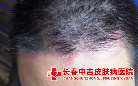 头部牛皮癣