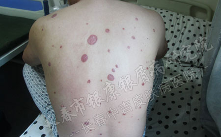 牛皮癣护理