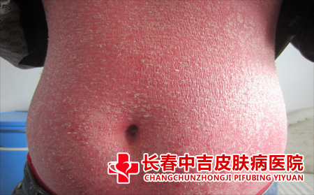 牛皮癣应该怎么进行护理