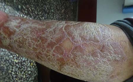 牛皮癣患者应该怎么进行护理