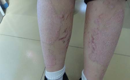 牛皮癣 有什么早期症状