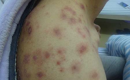 老年人发生牛皮癣的原因有什么