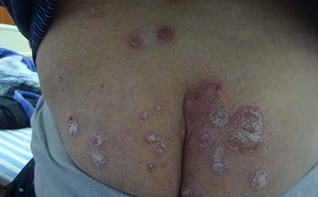 脓疱型牛皮癣有什么样的症状