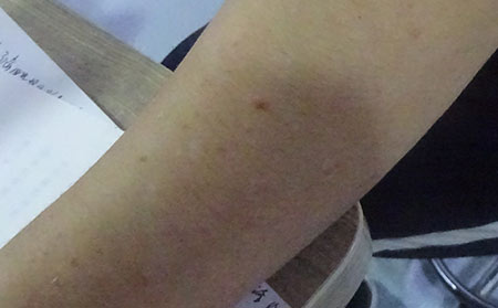 牛皮癣的护理方法有什么