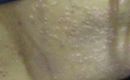 寻常型牛皮癣有什么症状