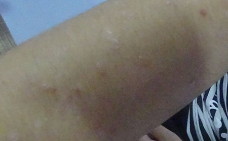 牛皮癣应该怎么进行护理