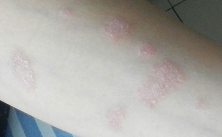 牛皮癣应该怎么进行护理