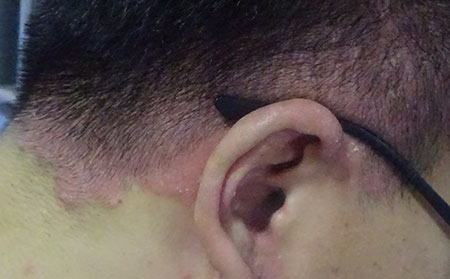 牛皮癣是什么原因造成的