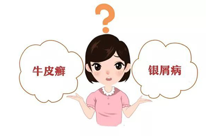 牛皮癣的预防方法有什么