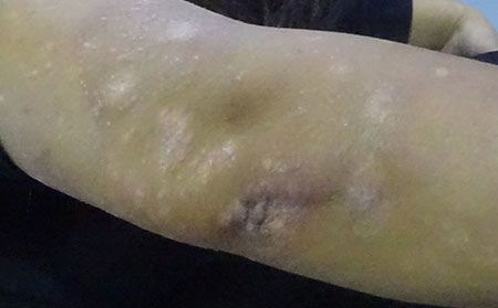 什么样的症状是牛皮癣