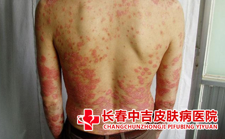 牛皮癣怎么进行预防