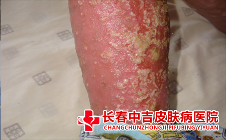 牛皮癣怎么进行治疗