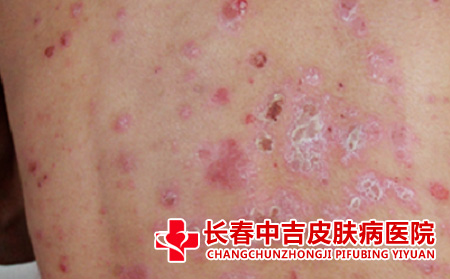 牛皮癣为什么会反复