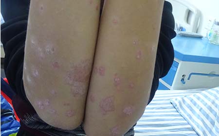 寻常型牛皮癣症状