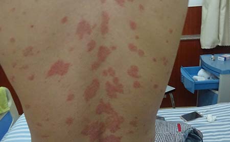 男性牛皮癣患者饮食注意什么