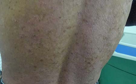 牛皮癣患者的药物治疗