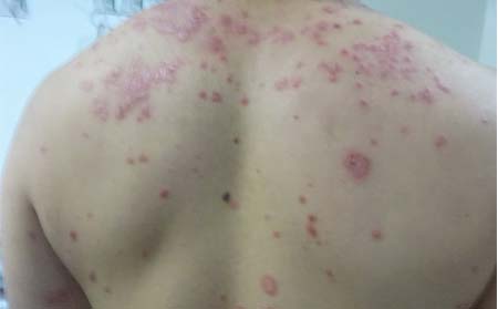 牛皮癣症状图片
