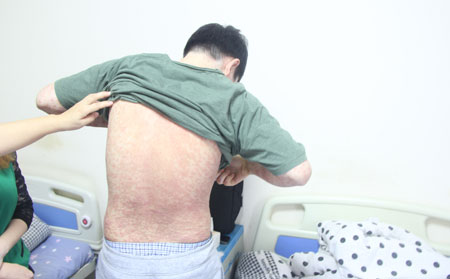 牛皮癣的治疗方法 