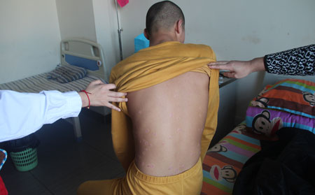 牛皮癣的治疗方法