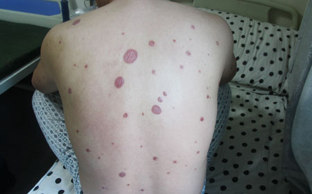 牛皮癣患者的护理方法