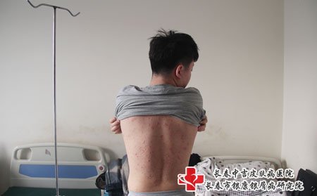 白城公立牛皮癣医院的地址在哪里,白城牛皮癣医院,长春牛皮癣医院