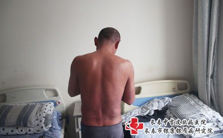 白城好的牛皮癣医院联系方式,白城牛皮癣医院,长春牛皮癣医院
