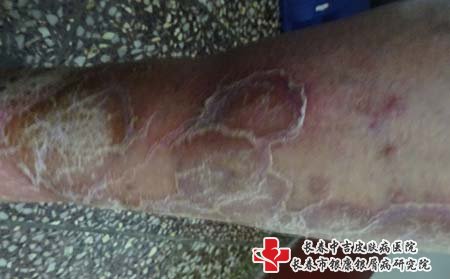 白城看牛皮癣医院怎么样,白城牛皮癣医院,长春牛皮癣医院