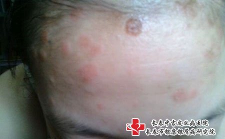 白城哪个医院治牛皮癣,白城牛皮癣医院,长春牛皮癣医院
