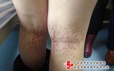 白城哪个医院治牛皮癣正规,白城牛皮癣医院,长春牛皮癣医院