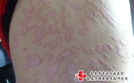 白城哪家医院治疗牛皮癣正规,白城牛皮癣医院,长春牛皮癣医院
