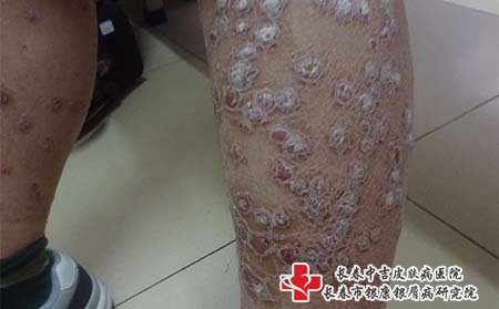 白城看牛皮癣什么医院好,白城牛皮癣医院,长春牛皮癣医院