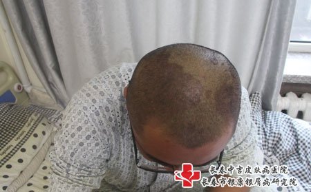 白山的牛皮癣治疗医院哪家好,白山牛皮癣医院,长春牛皮癣医院