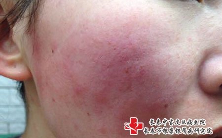 四平健康牛皮癣医院