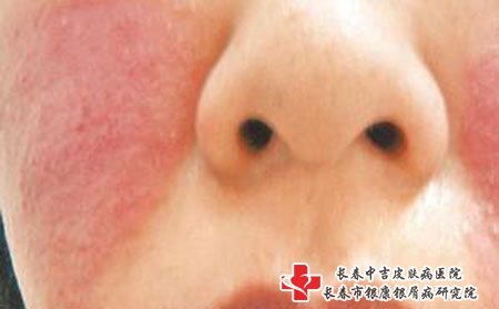 四平较好的牛皮癣专治医院