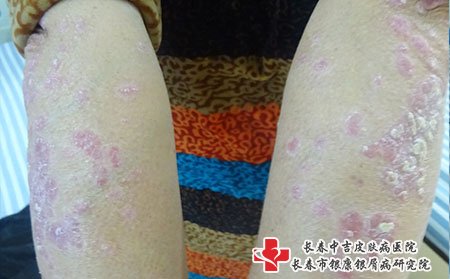 四平看牛皮癣哪里好