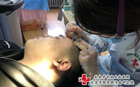 松原看牛皮癣哪里好