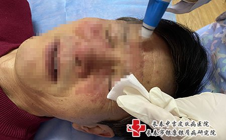 松原看牛皮癣去哪个医院好