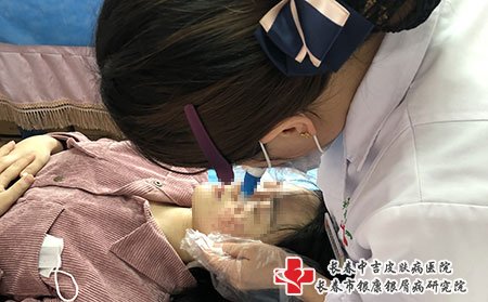 看牛皮癣长春哪个医院好些