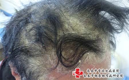 头部牛皮癣病因,为什么头上长牛皮癣
