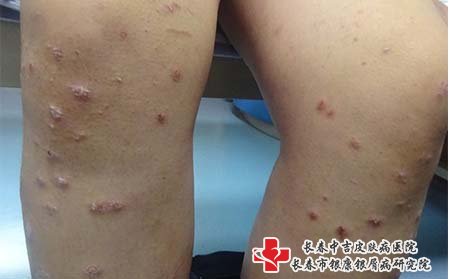 女性牛皮癣表现,女性牛皮癣有什么特点