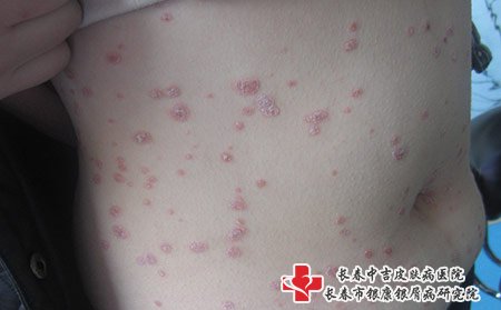 松原哪里的医院治疗牛皮癣好