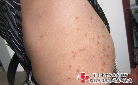 松原哪里的医院可以治好牛皮癣