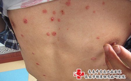 松原哪看牛皮癣好的快