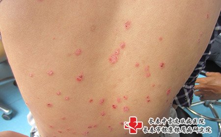 松原哪家牛皮癣医院不错
