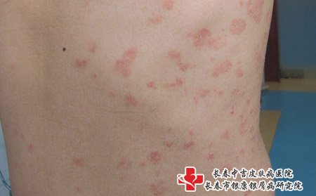 松原哪家医院专治牛皮癣