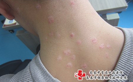 松原哪家医院专门治疗牛皮癣