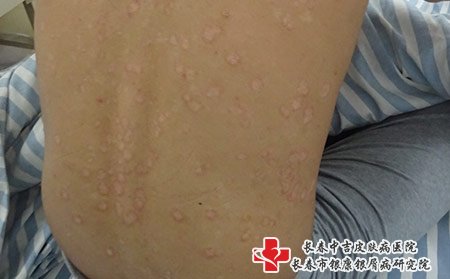 松原哪家医院治牛皮癣