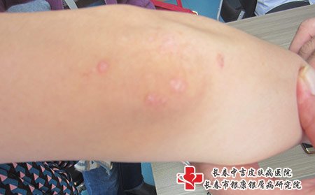 松原哪家医院治牛皮癣