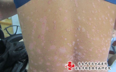 松原哪家医院治疗牛皮癣强