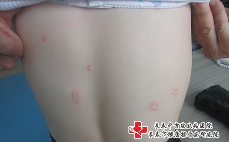 松原哪家医院治疗牛皮癣好